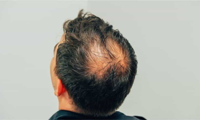 Conheça Os 4 Tipos De Alopecia E A Importância De Identificá-las ...