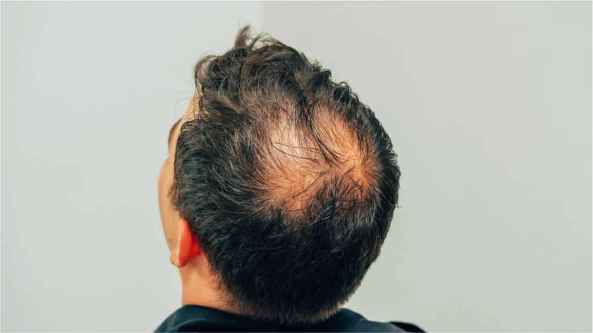 Conheça os 4 tipos de alopecia e a importância de identificá-las corretamente