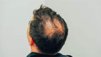 Conheça os 4 tipos de alopecia e a importância de identificá-las corretamente
